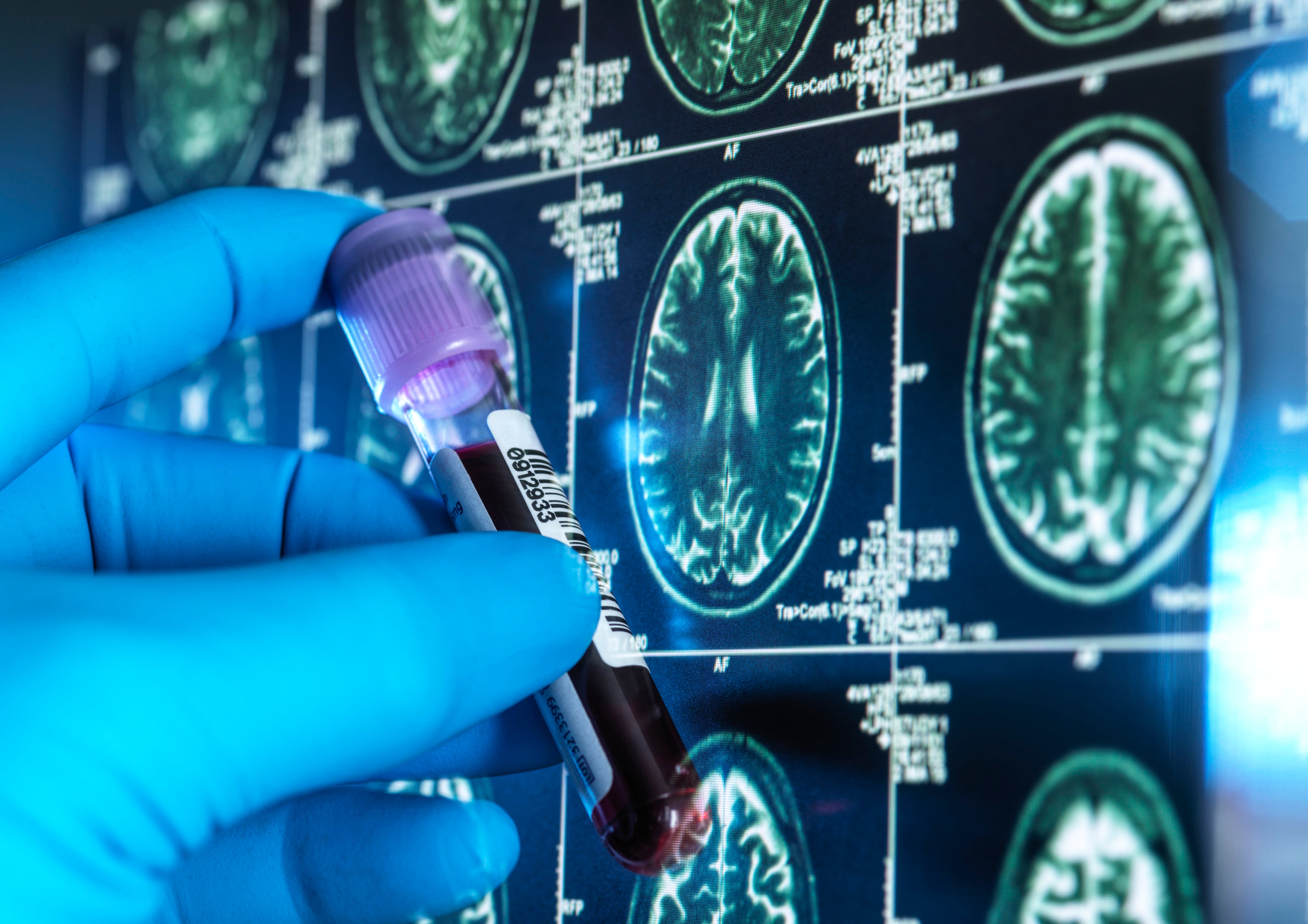 Medicamento podría retrasar la aparición del Alzheimer: así funciona