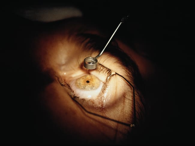 Cirugías oculares: experto revela los tiempos de recuperación, riesgos y edades permitidas